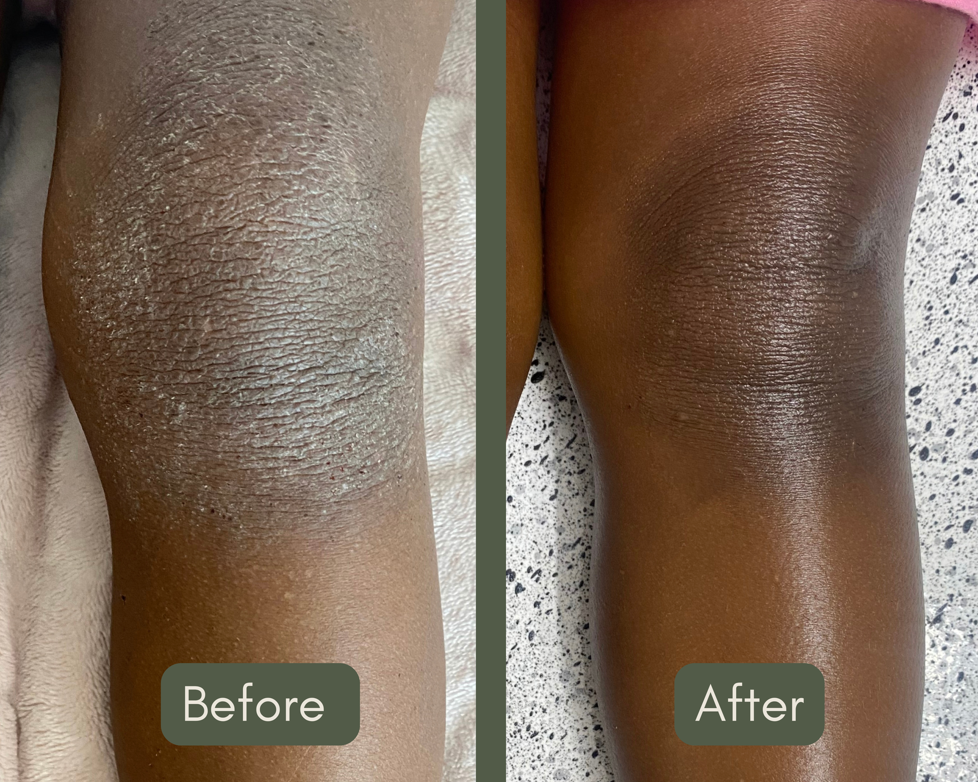 Before and after comparison of a leg with visible skin improvement from dry irritated eczema to clear moisturised glowing and healthy skin, after using lavender dream body butter