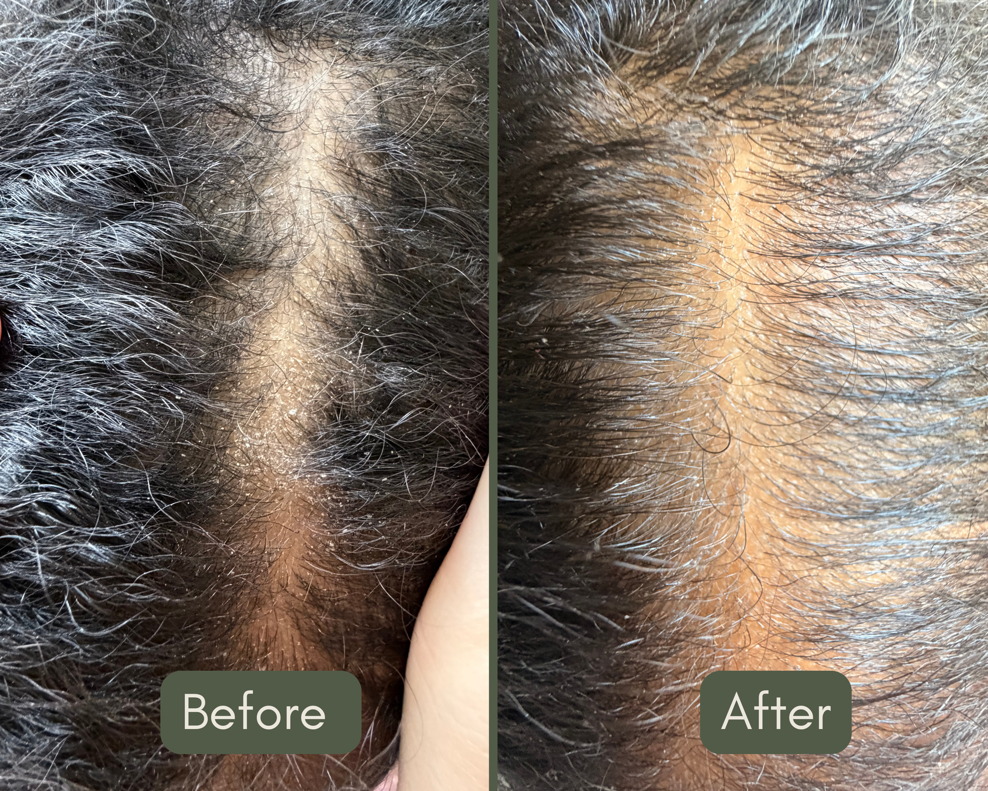 Before and after comparison of Goddess grow scalp oil treatment on a person's scalp showing a dry scalp before and a healthy moisturized scalp after