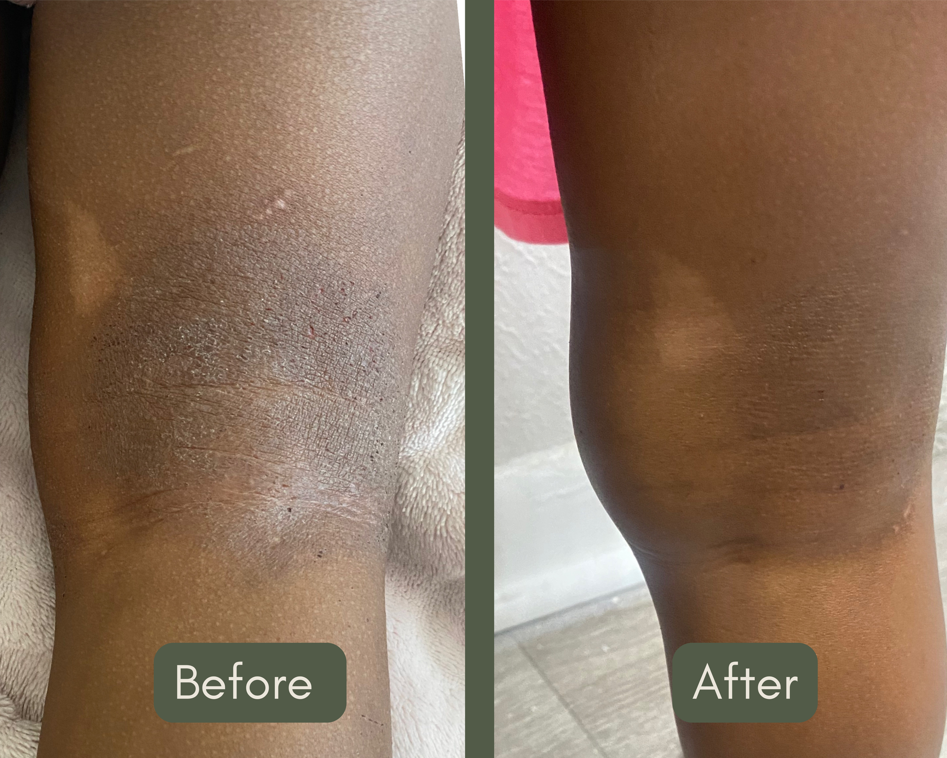 Before and after comparison of a leg with visible skin texture changes.